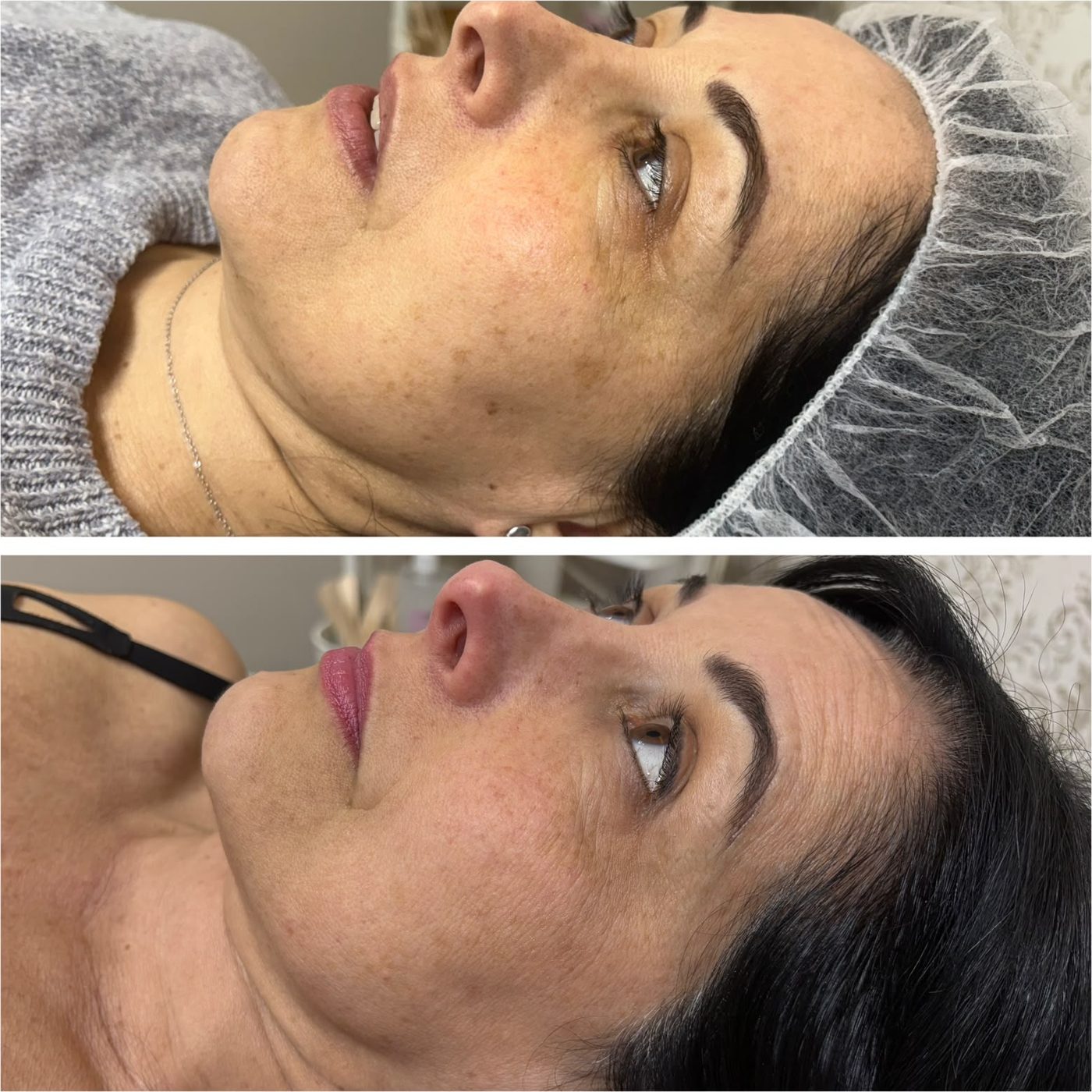 Antes y después de IPL en manchas